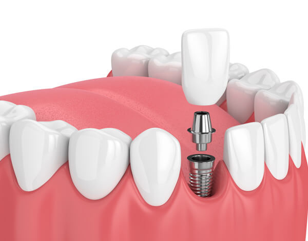 dental implants