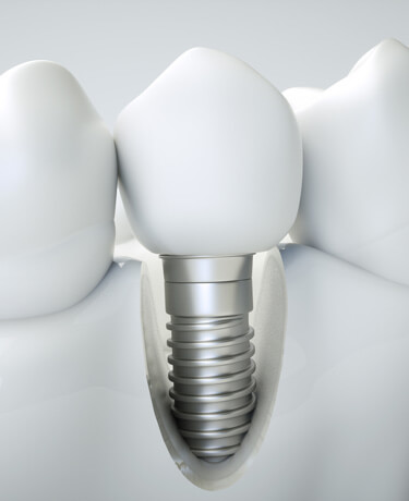 Dental Implants