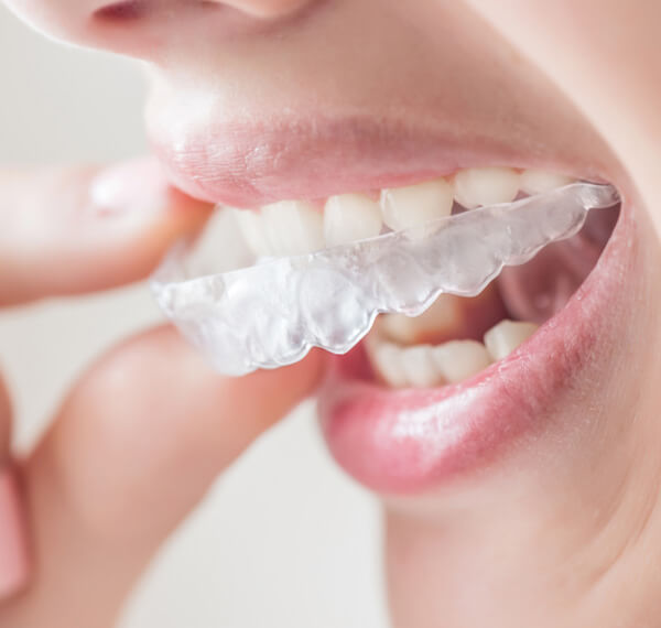 Invisalign Clear Aligners