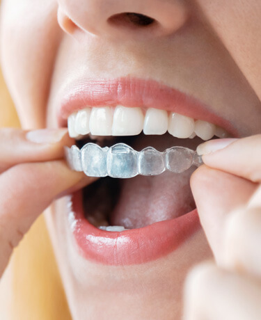 Invisalign