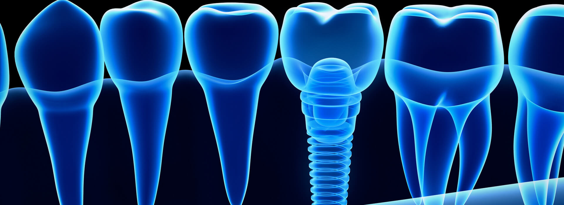 Dental Implants