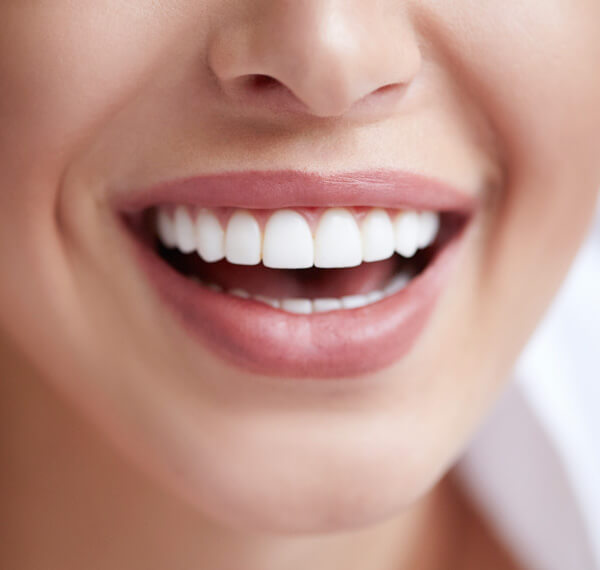 What are Veneers?