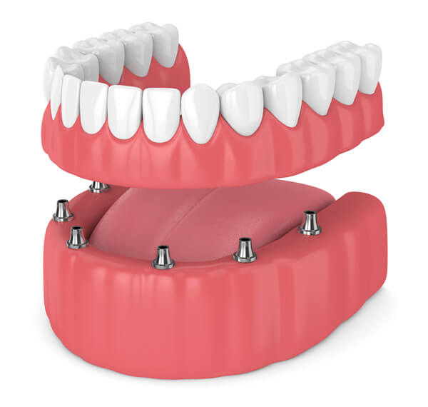 What is All-on-4 dental implant treatment?