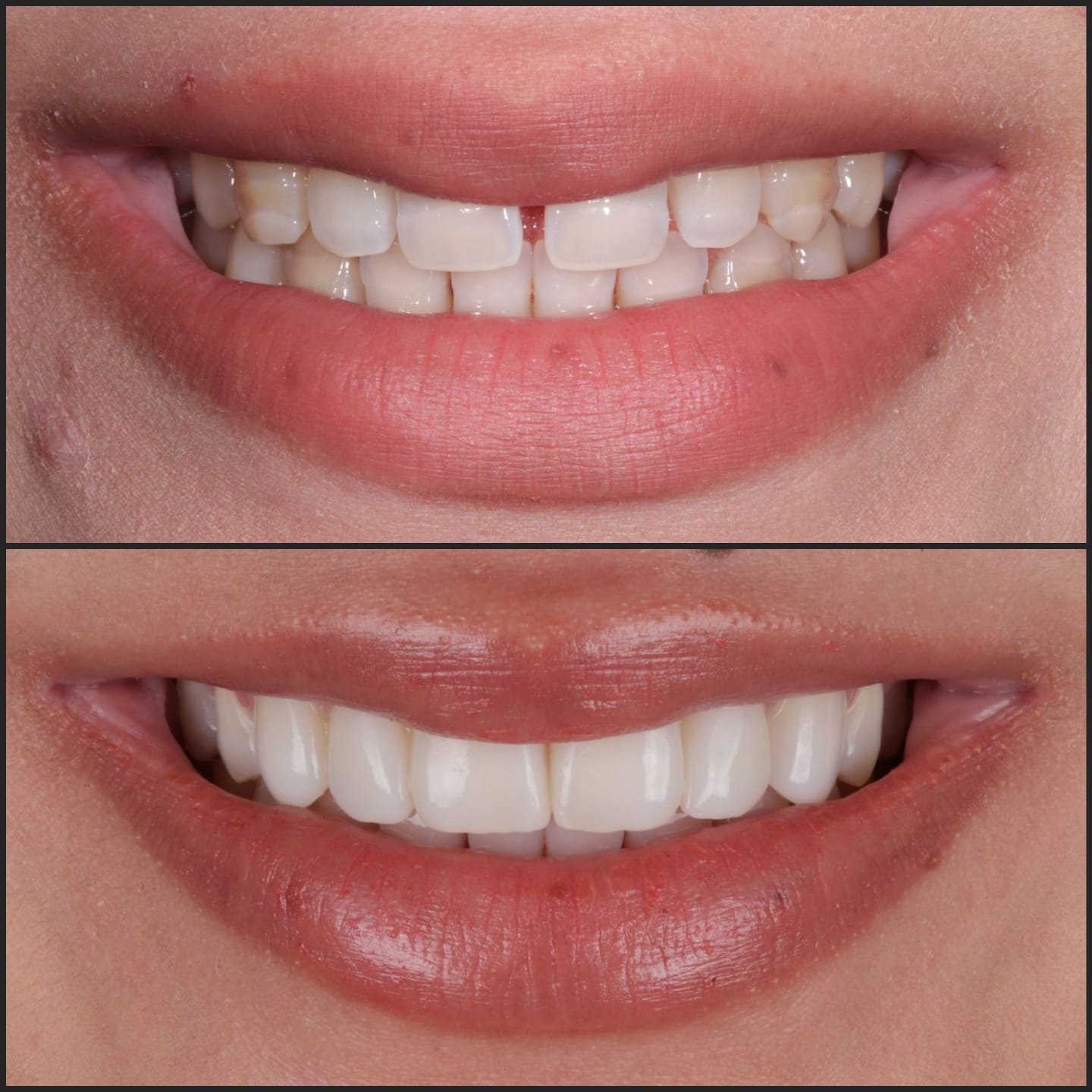 before after